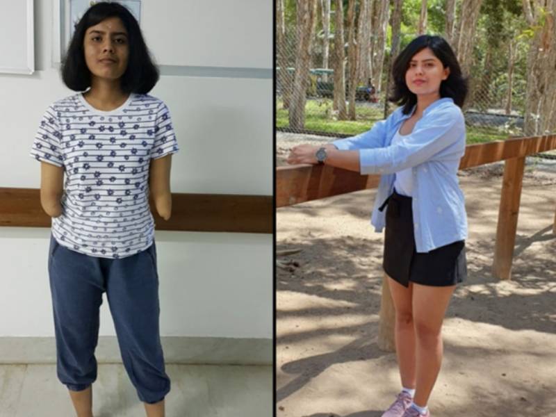 Shreya before and after organ donation