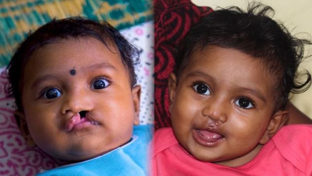 Baby Jaya before and after cleft surgery - World Smile Day