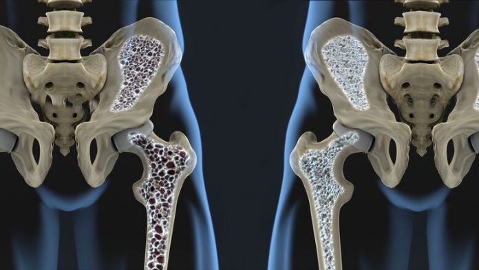 CSR: Nationwide Campaign on World Osteoporosis Day Launched