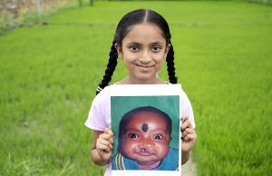 Smile Train and Sirat unite to transform smiles and empower India's cleft community